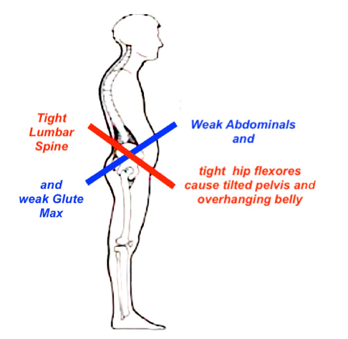 An image of a anteriorly tilted pelvis