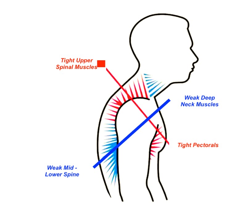 an image of hunched shoulder head forward posture